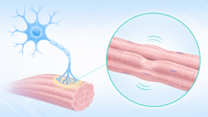運動ニューロンと筋線維束のイラスト：Benign Fasciculation Syndrome（BFS）における筋肉のぴくつきの模式図